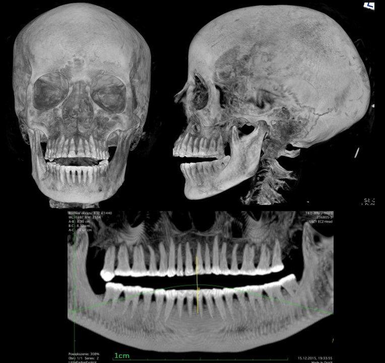 Zdjęcia rentgenowskie czaszki tajemniczej kobiety (fot. Marcin Jaworski)