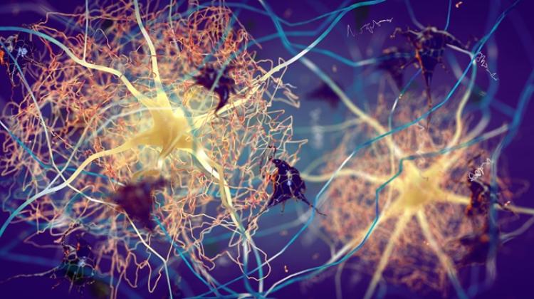Białko Beta-amyloid i neurony w mózgu osoby chorej na Alzheimera.Adobe Stock